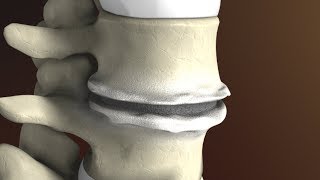 Degenerative Disc Disease Spondylosis explained by Spine Surgeon Dr Jessica Shellock Plano TX [upl. by Malina]