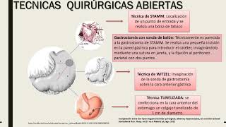 Proceso quirúrgico  GASTROSTOMIA [upl. by Burrow]