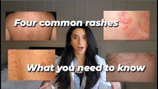 Four common rashes and everything you need to know about them [upl. by Meeker]