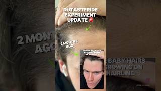 DUTASTERIDE HAIR GROWTH EXPERIMENT UPDATE 🚨 [upl. by Aisela]