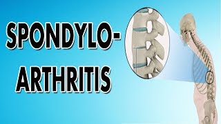 Spondyloarthropathy [upl. by Artenek]