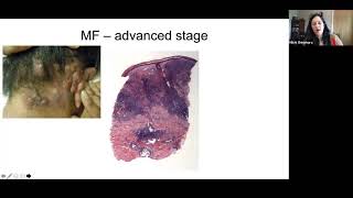 Pathology Grand Rounds  Cutaneous TCell Lymphoma  Dr Michi Shinohara [upl. by Sinnel]