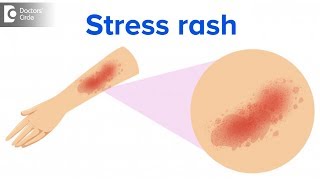 What is a stress rash  Dr Rajdeep Mysore [upl. by Arnst]