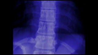 Areas of Inflammation in Ankylosing Spondylitis [upl. by Adao]