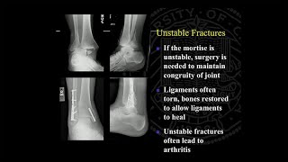 Ankle Replacement and Ankle Fusion Surgery and Recovery [upl. by Ailecec561]