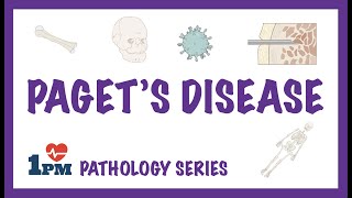 Pagets Disease  Pathology Causes Symptoms Diagnosis Treatment [upl. by Formenti]