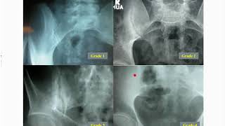 The Diagnosis and Management of Axial Spondyloarthritis [upl. by Sutsuj914]