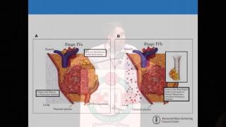 Huang Thymoma Thymic Carcinoma [upl. by Airamasor465]