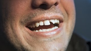 How to Deal with Broken Teeth  Tooth Care [upl. by Norbel566]