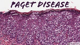 Extramammary Paget Disease 5Minute Pathology Pearls [upl. by Pinter150]