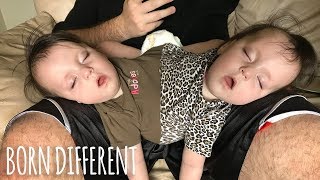 Conjoined Twins Are A Medical Miracle  BORN DIFFERENT [upl. by Farron]