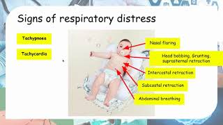 Suprasternal recession infant with laryngomalacia [upl. by Craven]