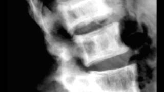 Pagets Disease of the Lumbar Spine on X ray [upl. by Joni]