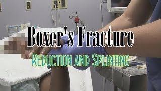 Boxers Fracture Reduction and Splinting [upl. by Nerak407]