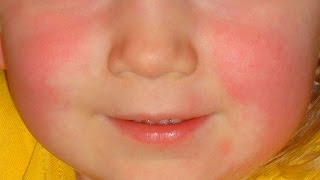 6 Common Rashes And What They Look Like  Healthline [upl. by Esli]