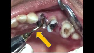 Piezo assisted grossly decayed maxillary teeth removal [upl. by Rabah]