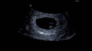 What Can You See At A 6 Week Baby Scan [upl. by Gnik]