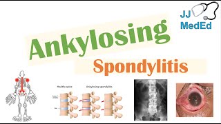 Ankylosing Spondylitis  HLAB27 Pathophysiology Signs amp Symptoms Diagnosis Treatment [upl. by Norvin]