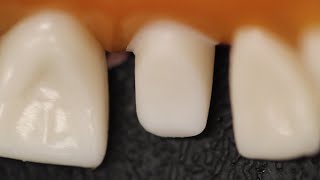 All Ceramic Crown Anterior Tooth Preparation [upl. by Uchida207]