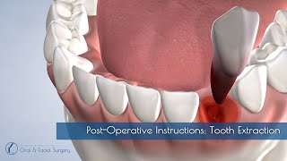 PostOperative Instructions Tooth Extraction [upl. by Attikram]