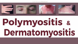 A Simplified Overview of Polymyositis amp Dermatomyositis  Clinical Features Diagnosis amp Treatment [upl. by Giesser]