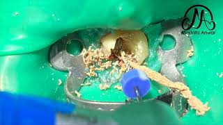 How To Remove GuttaPercha Easily During Root Canal Retreatment Cases  Easy GuttaPercha Removal [upl. by Norabel]