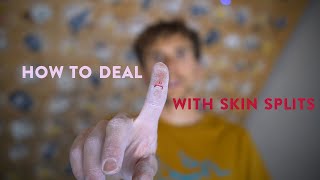 How To Take Care Of Skin Splits  Jonathan Siegrist Style [upl. by Nylaf]