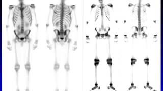 Essentials of Bone Scan  HD Basic Radiology [upl. by Nwonknu]