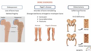 BONE DISORDERS AND TREATMENT [upl. by Creight]