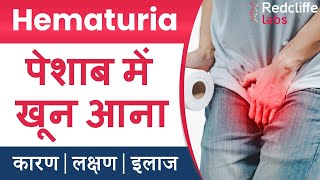 ⛔Hematuria पेशाब में खून आना  Symptoms And Causes in Hindi  ✅ Hematuria Blood in Urine का इलाज [upl. by Wollis447]