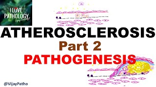 ATHEROSCLEROSIS  Part 2 Pathogenesis [upl. by Neehs]