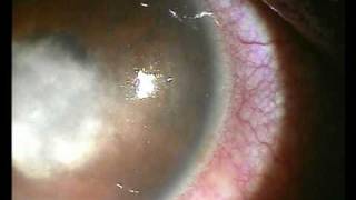 Hypopion Corneal Ulcermpg [upl. by Aoht]