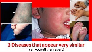 Kawasaki disease scarlet fever and rheumatic fever [upl. by Sehguh]