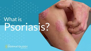 What Is Psoriasis [upl. by Gifford333]