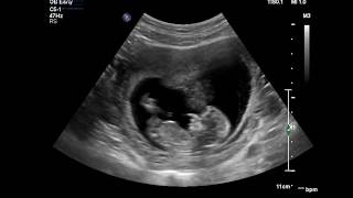 Advanced Early Pregnancy Scan 1219 weeks [upl. by Zetnahs]