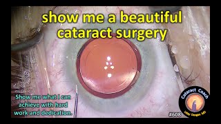 show me a beautiful cataract surgery [upl. by Bradwell501]