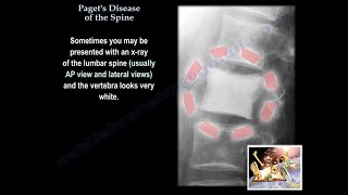 Pagets Disease Of The Spine  Everything You Need To Know  Dr Nabil Ebraheim [upl. by Fried155]