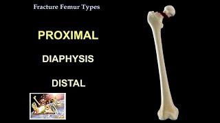 Fracture Femur Types  Everything You Need To Know  Dr Nabil Ebraheim [upl. by Beacham]