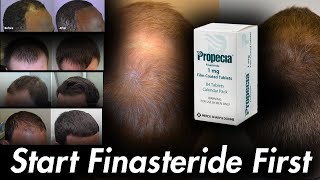 DONT USE Minoxidil Start Finasteride or Dutasteride [upl. by Luapleahcim]