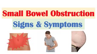 Small Bowel Obstruction SBO Signs amp Symptoms amp Why They Occur [upl. by Luas]