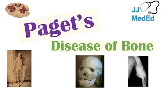 Paget’s Disease of Bone Osteitis Deformans  Causes Pathogenesis Symptoms Diagnosis amp Treatment [upl. by Lamoureux656]