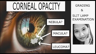 Corneal Opacity  Grading amp Clinical Examination  Adherent Leucoma Nebular Macular amp Leucomatous [upl. by Llenhoj]