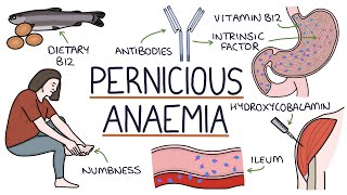 Understanding Pernicious Anaemia B12 Deficiency [upl. by Pawsner]