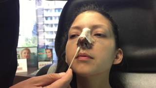 How to clean your nose after rhinoplasty [upl. by Davie]