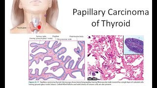 Pathology 818 a Papillary Carcinoma Thyroid Orphan Annie Eye Ground Lateral Aberrant psammoma bodies [upl. by Catherin]