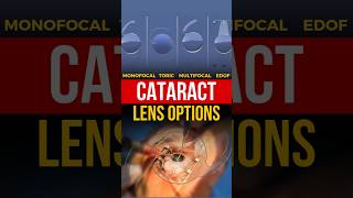 Latest 2025 Cataract Lens Options amp Cost [upl. by Siramaj13]