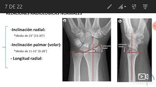 FRACTURAS DE RADIO DISTAL REVISIÓN DEL TEMA [upl. by Nhoj253]