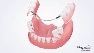 Behandlungsablauf Geschiebeprothese Zahnersatzsparende [upl. by Conners]