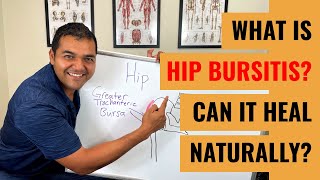 Injury Spotlight What is Hip Bursitis [upl. by Palocz]