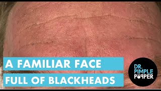 A Familiar Face Full of Blackheads [upl. by Hannala281]